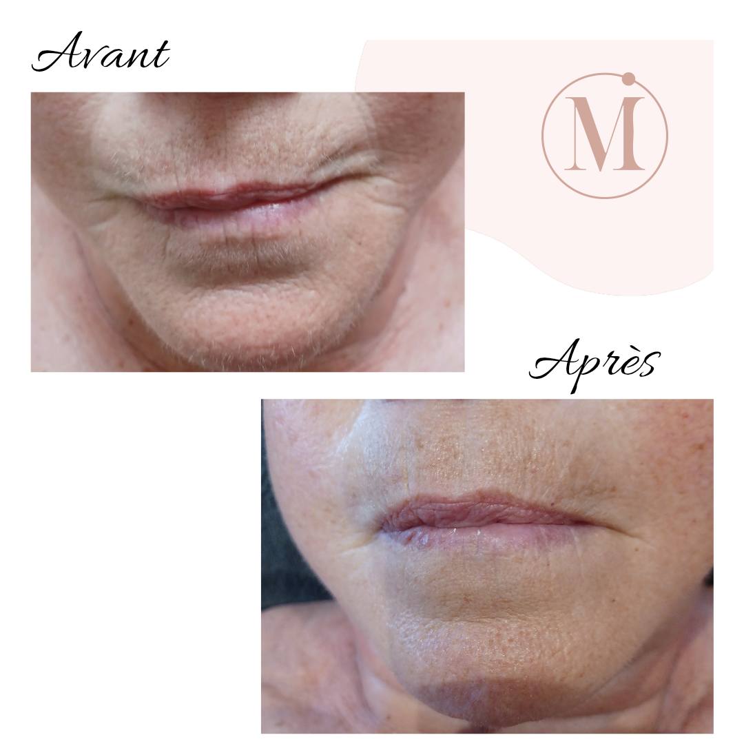 Résultat avant/après soin anti-âge - Réduction des rides et ridules