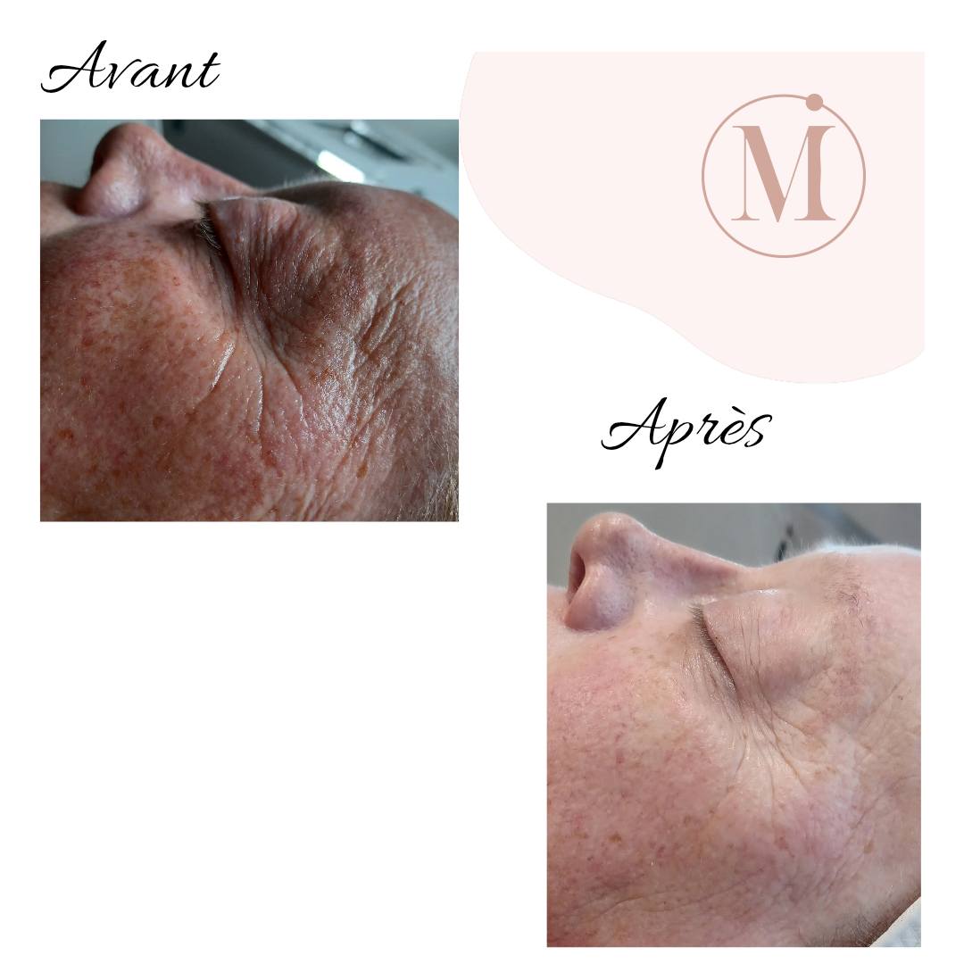 Résultat avant/après soin liftant - Raffermissement cutané